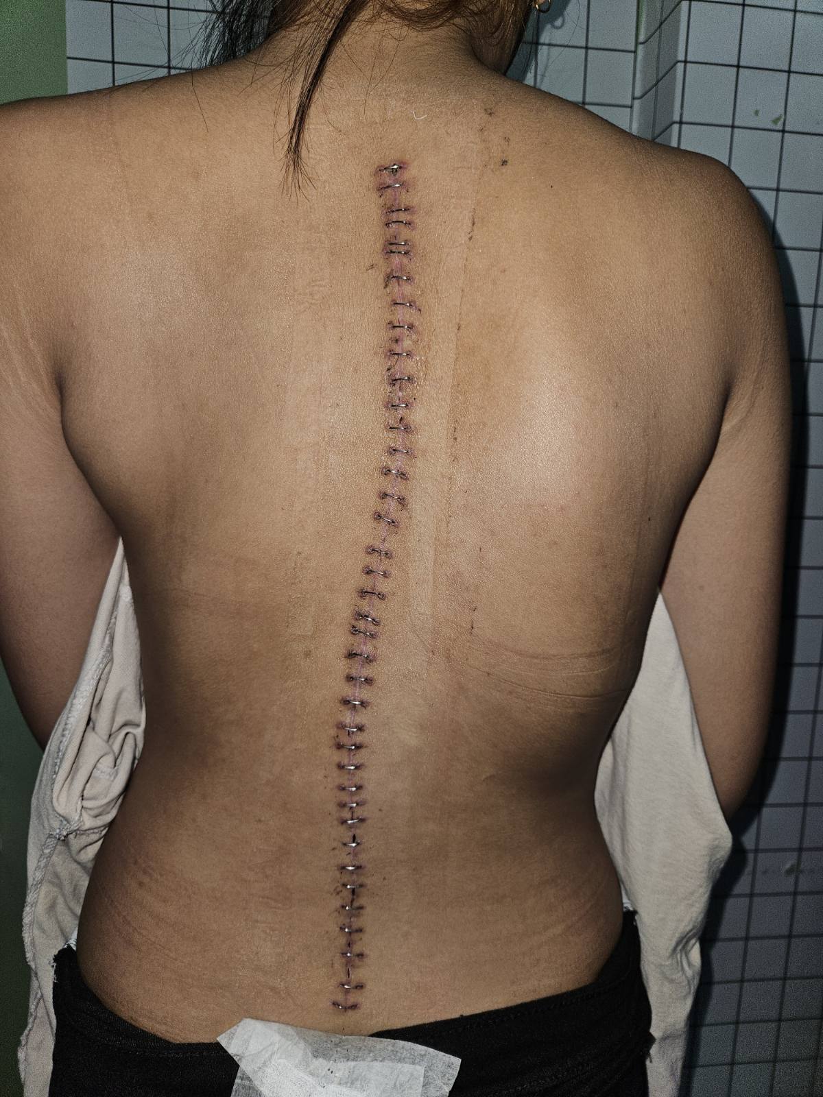 Advanced Wound Care Treatment 2 at Synergy Quezon City